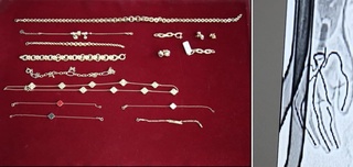 Протез орасига яширилган заргарлик буюмлари фош қилинди