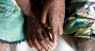 Эксперт ВОЗ: «Оспа обезьян - это не новый ковид, методы борьбы с вирусом понятны»