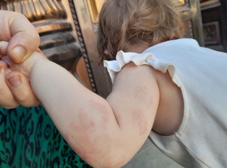 Андижондаги боғчада назоратсиз қолган болалар бир-бирига тан жароҳат етказди