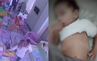 Bolaga qoʻpol harakati oqibatida tan jarohati yetkazgan enaga yordamchisiga jinoyat ishi ochildi