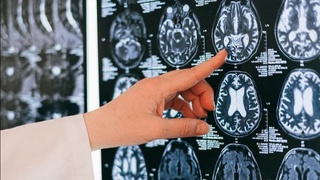 Nerv hujayralarini tiklash usuli topildi