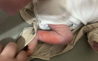 Oilaviy janjal oqibatida goʻdak bolaga qaynoq suv toʻkildi