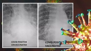 Vaksina olgan hamda olmagan — har ikkala holatda koronavirusga chalingan bemorlarning oʻpkasida qanday farq bor? — shifokor javob berdi