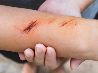 Яраларни электр токи билан даволаш усули ишлаб чиқилди