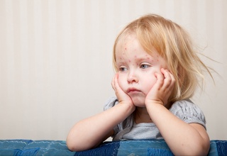 Qizamiq — jiddiy asoratlarni keltirib chiqaradigan kasallik: uning oldini olish uchun nima qilish kerak?