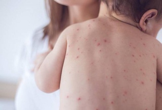 Санэпидкомитет подтвердил рост заболеваемости корью среди детей в Наманганской области