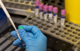 Россия Ўзбекистонга маймунчечакни аниқлаш учун тест тизимларини юборади