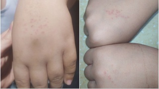 Oʻquvchilar qoʻliga igna sanchgan oʻqituvchiga nisbatan jinoyat ishi qoʻzgʻatildi