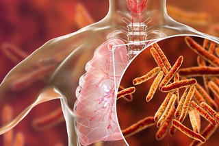 Елімізде туберкулез ауруына 70 минутта дәл нақтама қойылуда