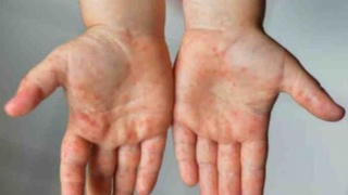 Болаларда кузатиладиган «Кавасаки синдроми» нима?