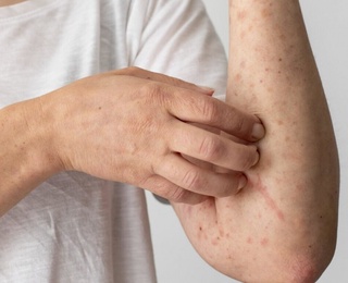 Qozog'istonda qizamiq bilan kasallanganlar soni 20 ming kishidan oshdi