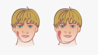 «Тепкиге» қарсы вакцина бар ма?
