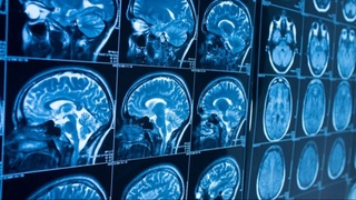 Альцгеймер касаллигини олдини олишнинг самарали усули топилди