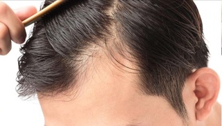 Экилган сочлар умрбод тўкилмайдими?