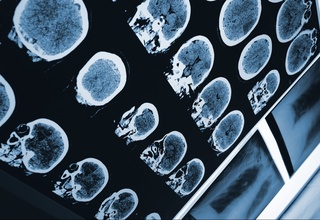 2050-yilga borib dunyoda insult bilan bog'liq bo'lgan o'lim ko'rsatkichi 50 foizga oshadi – olimlar