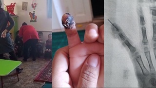 IIB bola qoʻliga igna qay tarzda kirganini tekshirmoqda — Bolalar ombudsmani