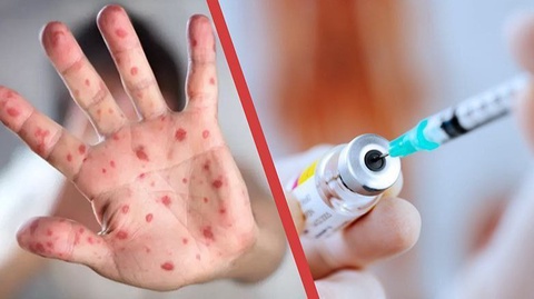 JSST qizamiqqa qarshi shoshilinch emlanishni tavsiya qildi