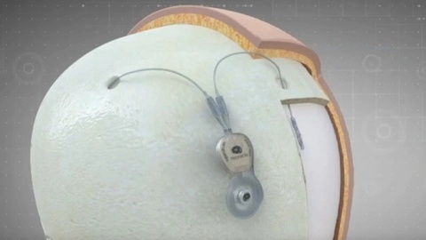 Xitoy dunyodagi birinchi miya signallarini yig‘uvchi invaziv moslamani ishga tushir