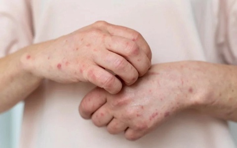 Bangladeshda qizamiq epidemiyasi: so‘nggi 24 soat ichida 17 kishi vafot etdi