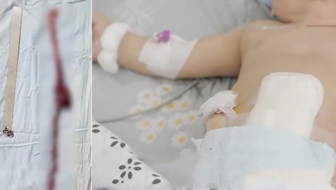 Тошкентда фастфуд сабаб 10 ойлик чақалоқнинг чириган ичаги кесиб ташланди