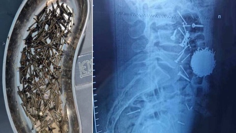 Шифокорлар самарқандлик бемор қорнидан 200 грамм мих олди