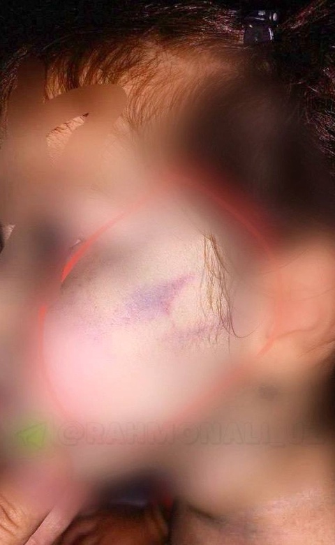 Toshkent viloyatida 2 yoshli bogʻcha tarbiyalanuvchisi kaltaklandi