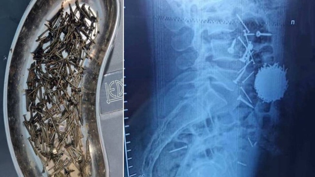 Шифокорон аз шиками бемори самарқандӣ 200 грамм мех берун оварданд